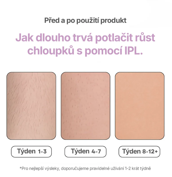 LUNELA: IPL Laser-Haarentferner